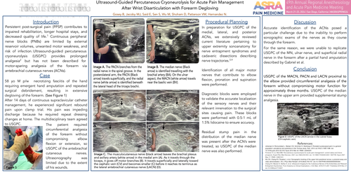 Preview of ULTRASOUND-GUIDED PERCUTANEOUS CRYONEUROLYSIS FOR ACUTE PAIN MANAGEMENT AFTER WRIST DISARTICULATION WITH FOREARM DEGLOVING