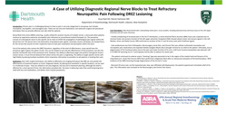 Thumbnail for A CASE OF UTILIZING DIAGNOSTIC REGIONAL PERIPHERAL NERVE BLOCKS REFRACTORY TO TREAT NEUROPATHIC PAIN FOLLOWING DREZ LESIONING.
