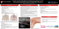 Thumbnail for SERRATUS ANTERIOR PLANE BLOCK AND MONITORED ANESTHESIA CARE FOR SUBCUTANEOUS IMPLANTABLE CARDIOVERTER DEFIBRILLATOR PLACEMENT