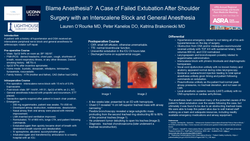 Thumbnail for BLAME ANESTHESIA?  A CASE OF FAILED EXTUBATION AFTER SHOULDER SURGERY WITH AN INTERSCALENE BLOCK AND GENERAL ANESTHESIA