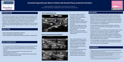 Thumbnail for SUCCESSFUL SUPRACLAVICULAR BLOCK IN PATIENT WITH BRACHIAL PLEXUS ANATOMICAL VARIATION