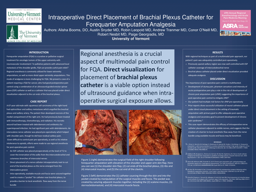 Preview of INTRAOPERATIVE DIRECT PLACEMENT OF BRACHIAL PLEXUS CATHETER FOR FOREQUARTER AMPUTATION ANALGESIA