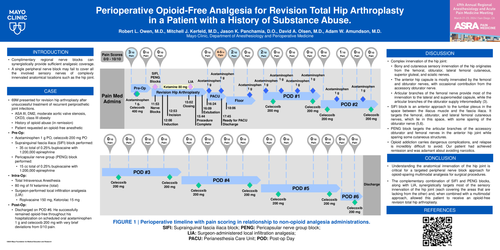 Preview of PERIOPERATIVE OPIOID-FREE ANALGESIA FOR REVISION TOTAL HIP ARTHROPLASTY IN A PATIENT WITH A HISTORY OF SUBSTANCE ABUSE.