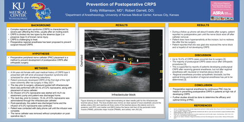 Preview of PREVENTION OF POSTOPERATIVE CRPS