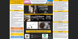 Thumbnail for PNS DEVICE IN 4 LIMB AMPUTATION: NO PAIN OR MEDS SINCE IMPLANT/EXPLANT