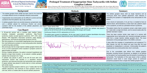 Preview of PROLONGED TREATMENT OF INAPPROPRIATE SINUS TACHYCARDIA WITH STELLATE GANGLION CATHETER