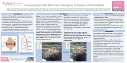 Thumbnail for CRYONEUROLYSIS AFTER TOTAL KNEE ARTHROPLASTY IN PATIENTS WITH HEMOPHILIA