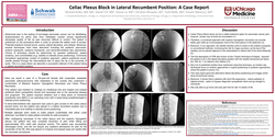 Thumbnail for CELIAC PLEXUS BLOCK IN LATERAL RECUMBENT POSITION: A CASE REPORT
