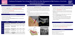 Thumbnail for CONTINUOUS PERICAPSULAR NERVE GROUP BLOCK (PENG) FOR PAIN MANAGEMENT IN HIP FRACTURES, A CASE SERIES