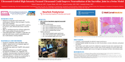Thumbnail for ULTRASOUND-GUIDED HIGH-INTENSITY FOCUSED ULTRASOUND COULD IMPROVE NEUROABLATION OF THE SACROILIAC JOINT IN A SWINE MODEL