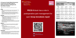 Thumbnail for DOUBLE-BLINDED RANDOMIZED CONTROL TRIAL ON THE PECS II BLOCK​ IN ARTHROSCOPIC ROTATOR CUFF REPAIR WITH OPEN BICEPS TENODESIS