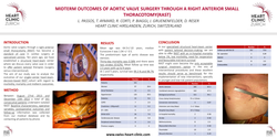 Thumbnail for Midterm Outcomes Of Aortic Valve Surgery Through A </sub> Right Anterior Small Thoracotomy (rast)</sub>