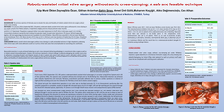 Thumbnail for Robotic Assisted Mitral Valve Surgery Without Aortic Cross Clamping A Safe And Feasible Technique