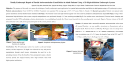 Thumbnail for Totally Endoscopic Surgical Repair Of A Partial Atrioventricular Canal Defect In Adult Patients Using A 3d High Definition Endoscopic System
