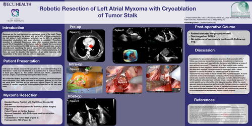 Preview of Robotic Resection Of Left Atrial Myxoma With Cryoablation Of Tumor Stalk