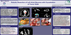 Thumbnail for Robotic Resection Of Left Atrial Myxoma With Cryoablation Of Tumor Stalk