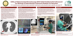 Thumbnail for Utility Of Robot-assisted Bronchoscopy With Radial Endobronchial Ultrasound For Marking Of Subcentimeter Pulmonary Nodules For Resection