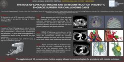 Thumbnail for The Role Of Advanced Imagine And 3d Reconstruction In Robotic Thoracic Surgery For Challenging Cases