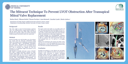 Preview of The Mitracut Technique To Prevent Left Ventricular Outflow Tract Obstruction During Transcatheter Mitral Valve Replacement