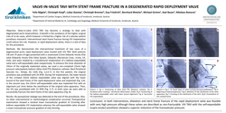 Thumbnail for Valve-in-valve Tavi With Stent Frame Fracture In A Degenerated Rapid Deployment Valve
