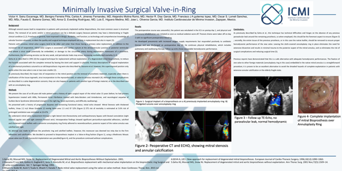 Preview of Minimally Invasive Surgical Valve-in-Ring