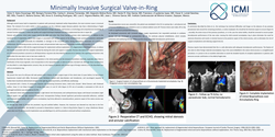 Thumbnail for Minimally Invasive Surgical Valve-in-Ring
