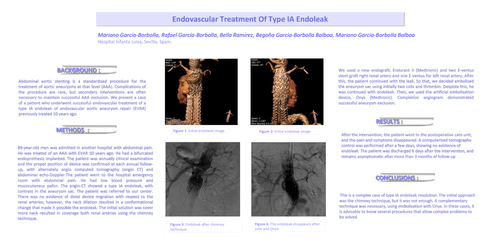 Preview of Endovascular Treatment Of Type IA Endoleak