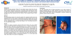 Thumbnail for Early Outcomes Of Minimally Invasive Aortic Valve Replacement With The Trifecta Valve Via A Right Anterior Minithoracotomy