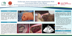 Thumbnail for Endoscopic Aortic Sutureless Valve Implantation With Concomitant Mitral Valve Repair