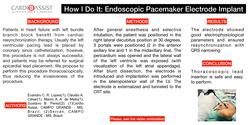Thumbnail for How I Do It: Endoscopic Pacemaker Electrode Implant
