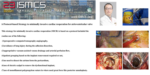 Preview of A Protocol-based Strategy To Minimally Invasive Cardiac Reoperation For Atrioventricular Valve