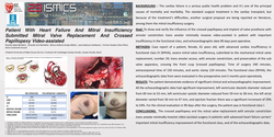 Thumbnail for Patient With Heart Failure And Mitral Insufficiency Submitted Mitral Valve Replacement And Crossed Papillopexy Video-assisted
