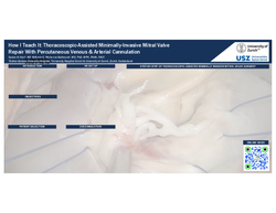 Thumbnail for Thoracoscopic Assisted Minimally-Invasive Mitral Valve Repair