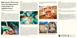 Thumbnail for Right Anterior Thoracotomy Aortic Valve Replacement In A Patient With Cold Agglutinin Disease