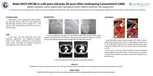 Preview of Redo Mics Opcab In A 68 Years Old Male 20 Years After Undergoing Conventional Cabg