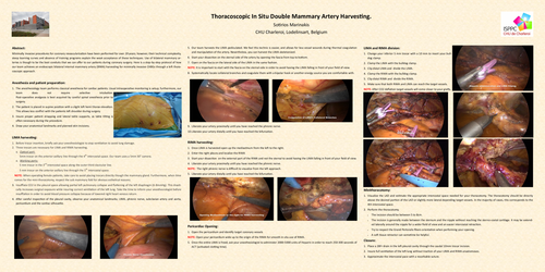 Preview of Thoracoscopic In Situ Double Mammary Artery Harvesting