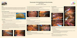Thumbnail for Thoracoscopic In Situ Double Mammary Artery Harvesting