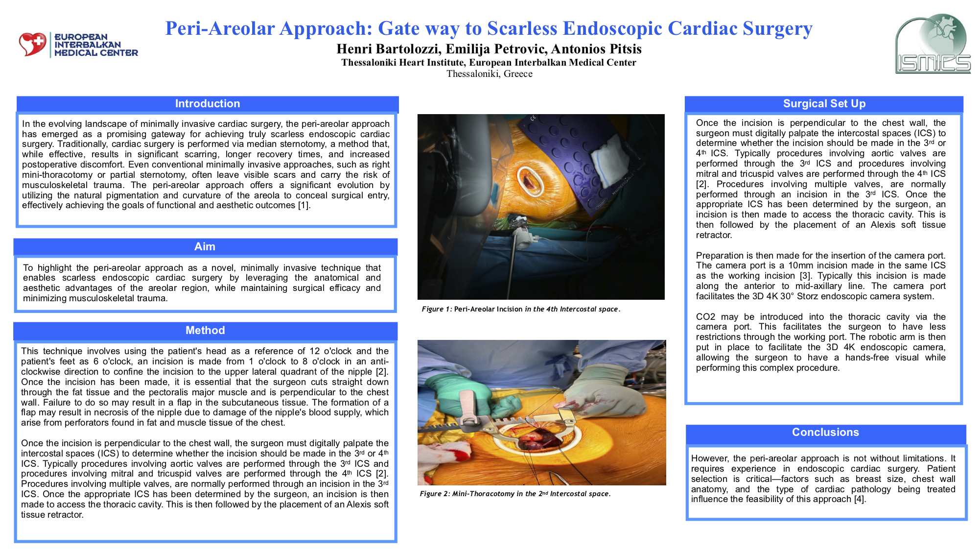 Preview of Peri-areolar Approach: Gate Way To Scarless Endoscopic Cardiac Surgery