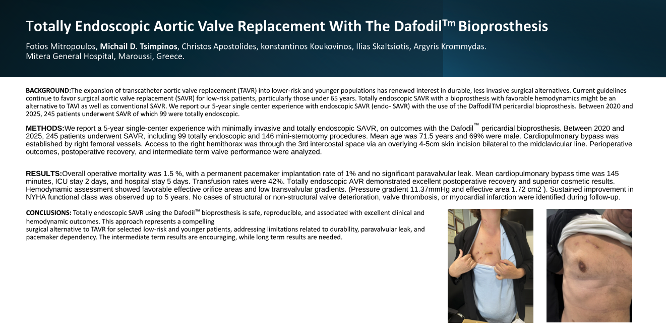 Thumbnail for Totally Endoscopic Aortic Valve Replacement With The DafodilTmBioprosthesis