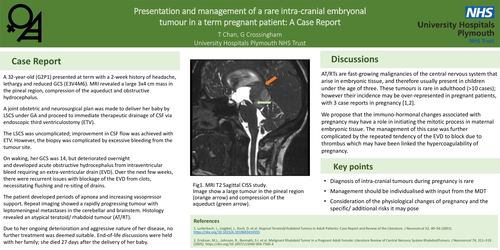 Preview of Presentation and management of a rare intra-cranial embryonal tumour in a term pregnant patient