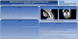 Thumbnail for Nifedipine induced acute submandibular swelling.