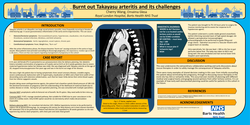 Thumbnail for Burnt out Takayasu arteritis and its challenges