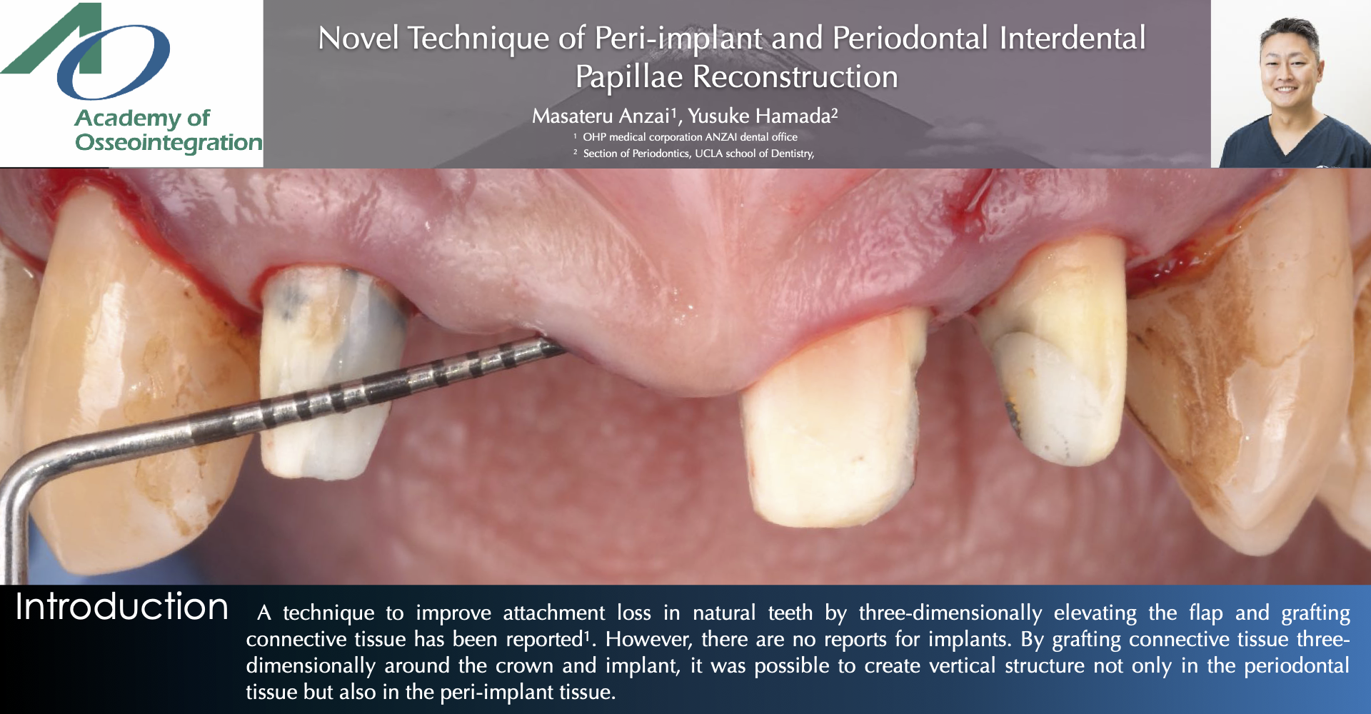 Thumbnail for Novel Technique of Peri-implant and Periodontal Interdental Papillae Reconstruction