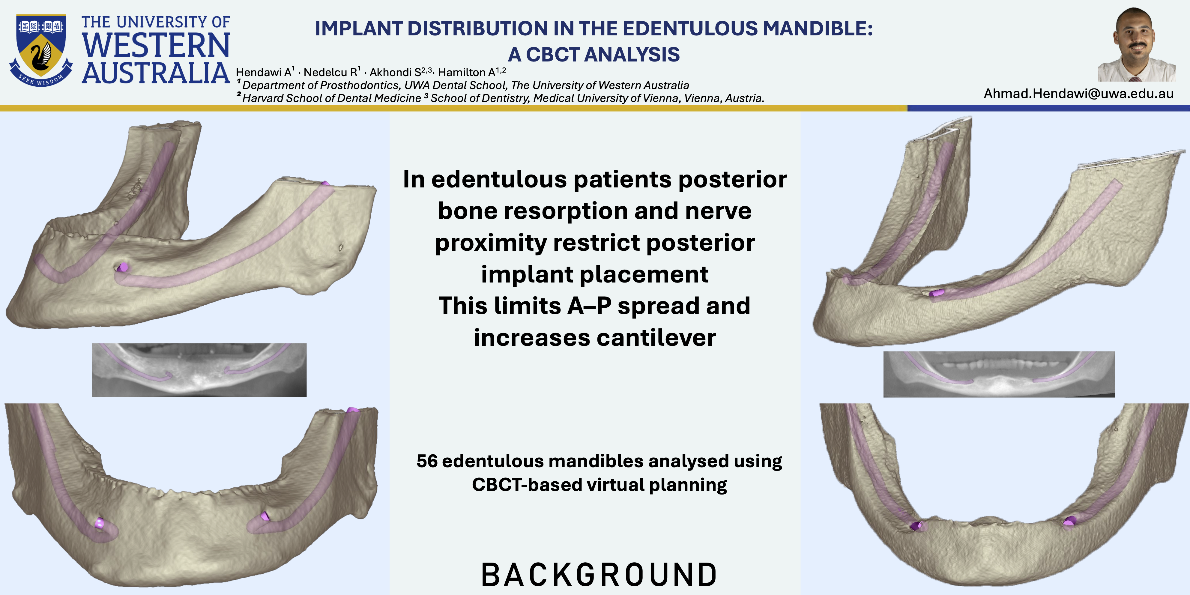 Thumbnail for Tilted Versus Axial Implant Distribution in the Posterior Edentulous Mandible: A CBCT Analysis