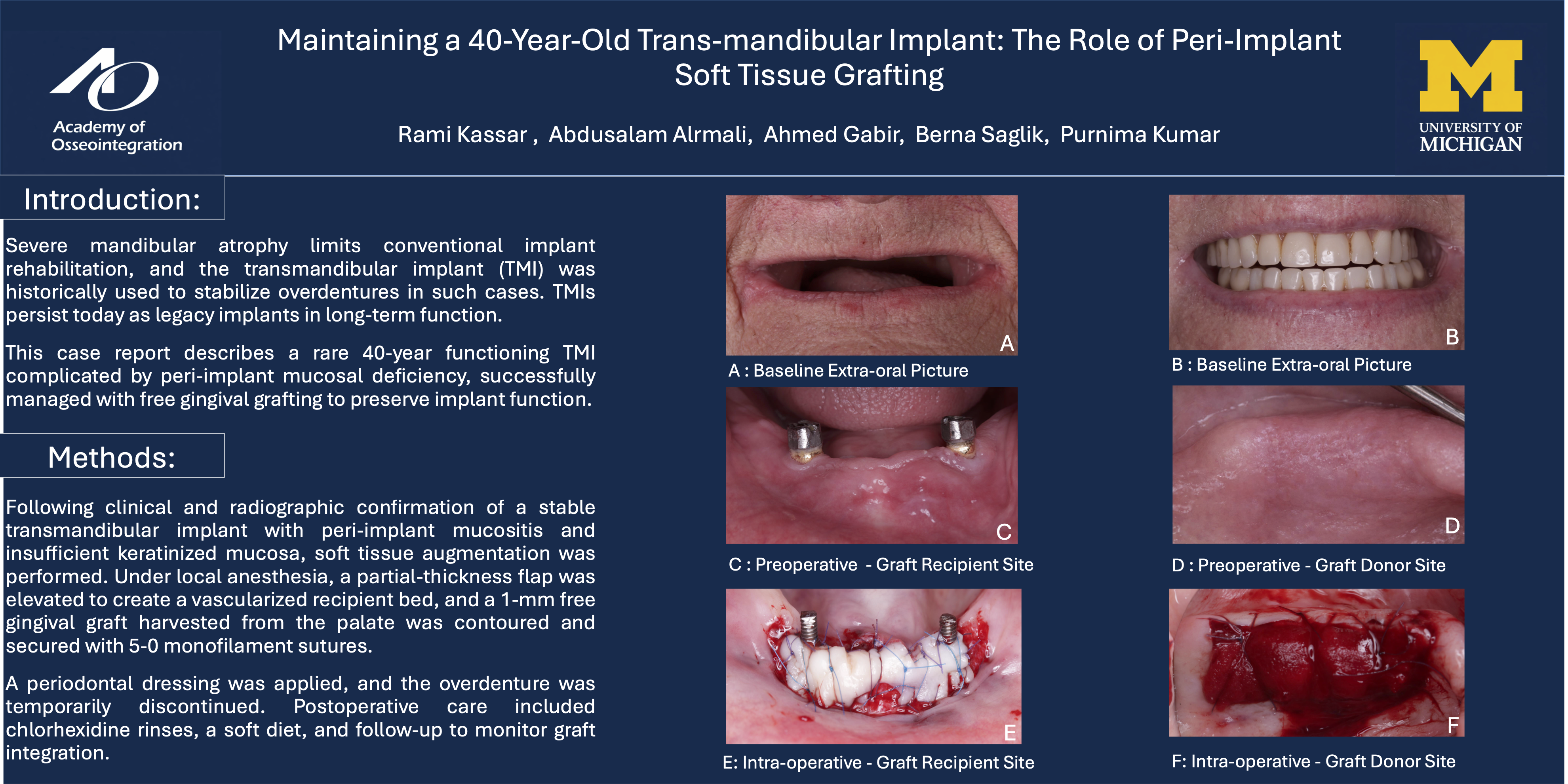 Thumbnail for Prosthetic and Soft Tissue Optimization With a Customized Overdenture Attachment: A 40-year Journey of a Transosteal Implant