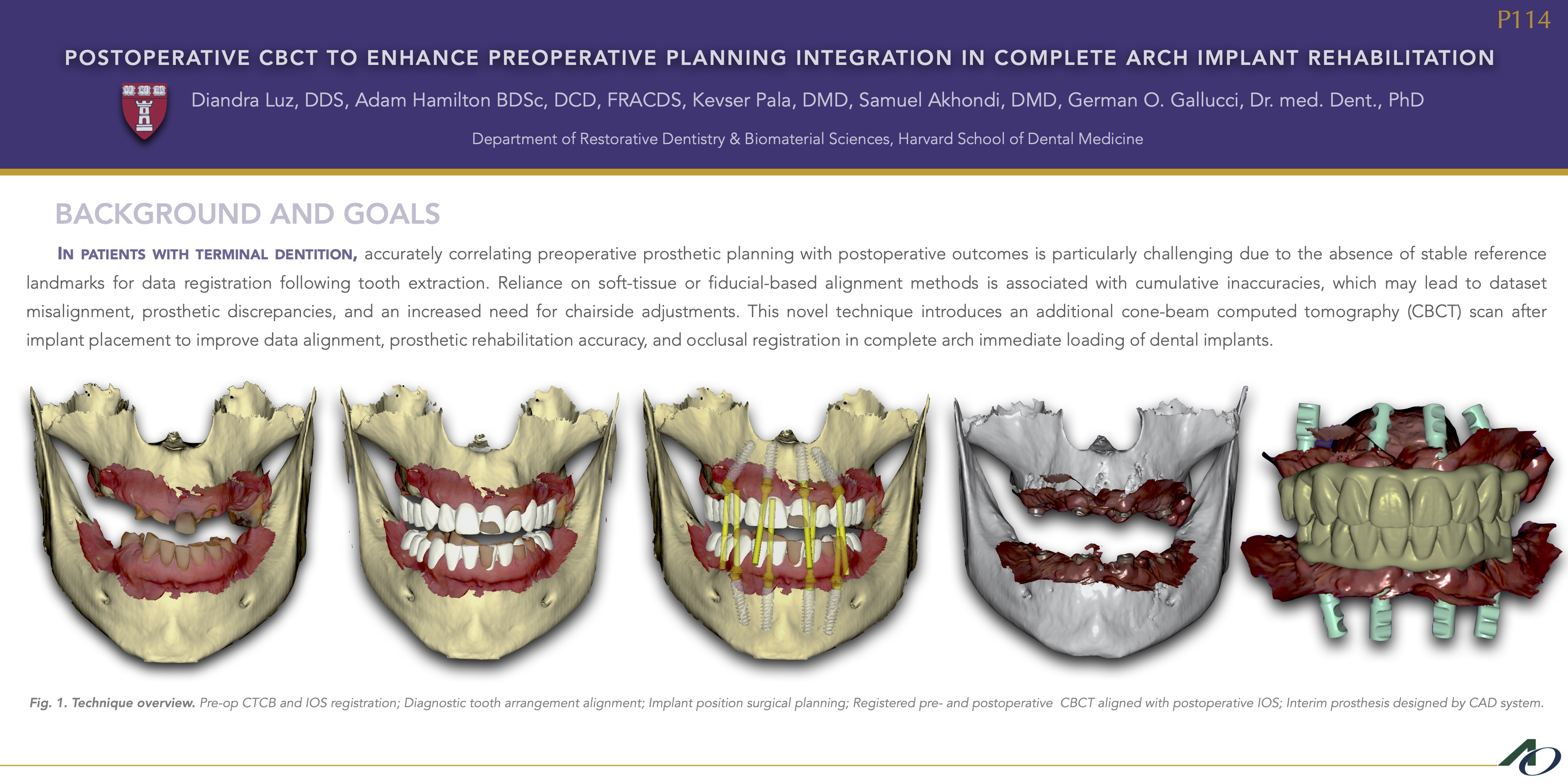 Thumbnail for Utilizing Post-operative CBCT to Enhance Pre-operative Planning Integration in Full-arch Implant Rehabilitation