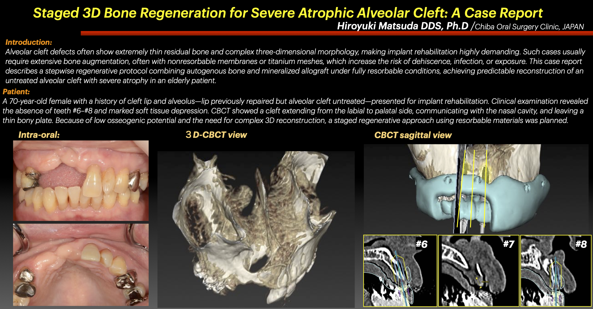 Thumbnail for Staged 3D Bone Regeneration for Severe Atrophic Alveolar Cleft: A Case Report
