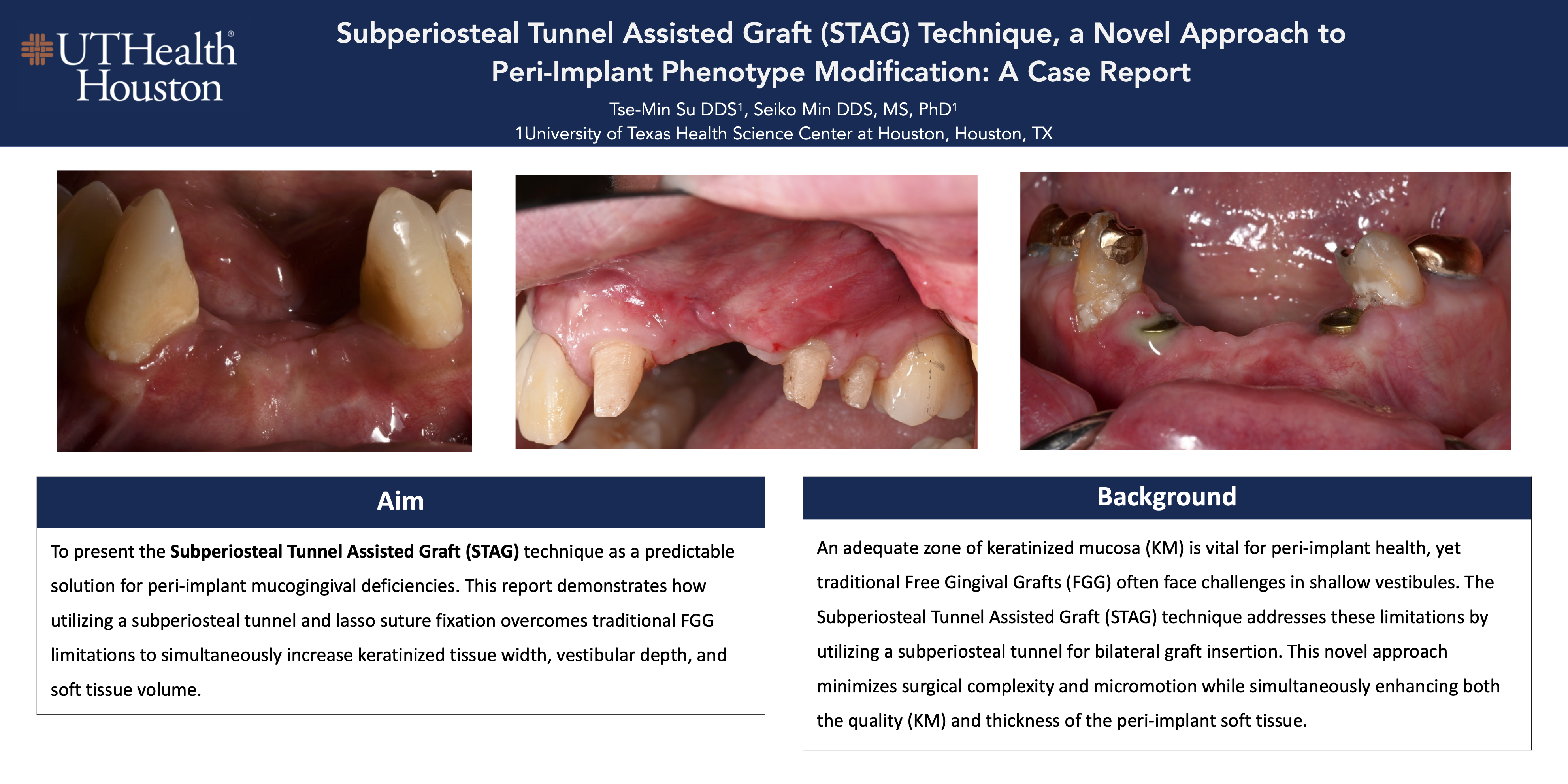 Thumbnail for Subperiosteal Tunnel Assisted Graft (STAG) Technique, a Novel Approach to Keratinized Tissue Augmentation for Peri-Implant Mucosal Enhancement: A Case Report