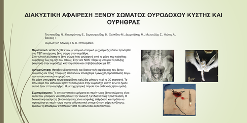 Preview of Διακυστική αφαίρεση ξένου σώματος ουροδόχου κύστης και ουρήθρας