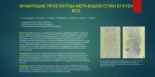 Preview of Φυματιώδης προστατίτιδα μετά ενδοκυστική έγχυση BCG